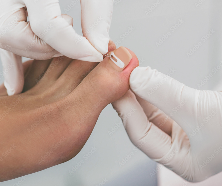 Medicinska pedikura - podologija v salonu Zoja Beauty