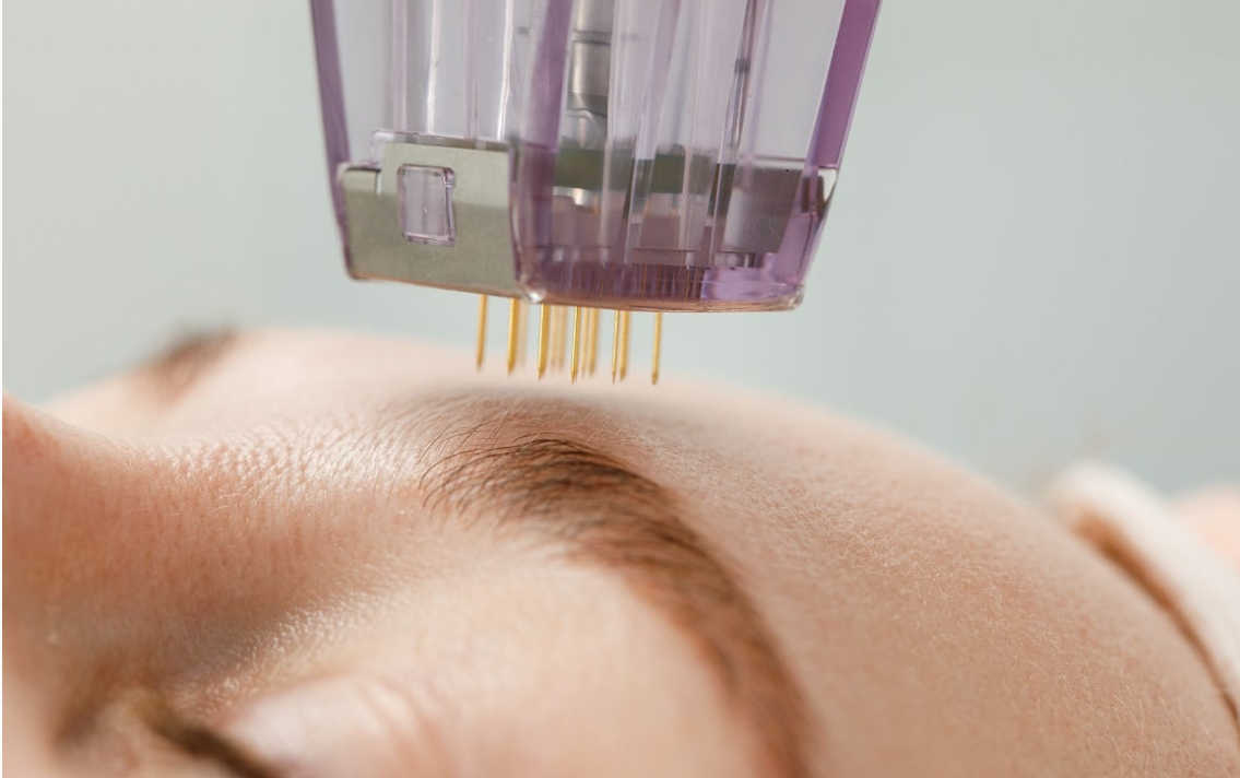Microneedling kartuša za tretma obraza v salonu Zoja Beauty